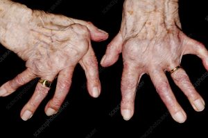 Arthritic hands of a 93 year old female patient with rheumatoid arthritis. The finger joints have become inflamed and swollen. Rheumatoid arthritis is caused by the immune system attacking the body's own tissues, causing progressive joint and cartilage destruction. As the cartilage is worn away, new bone grows as part of the repair process. This causes stiffness and deformity of the fingers. Treatment is with anti-inflammatory drugs and physiotherapy.